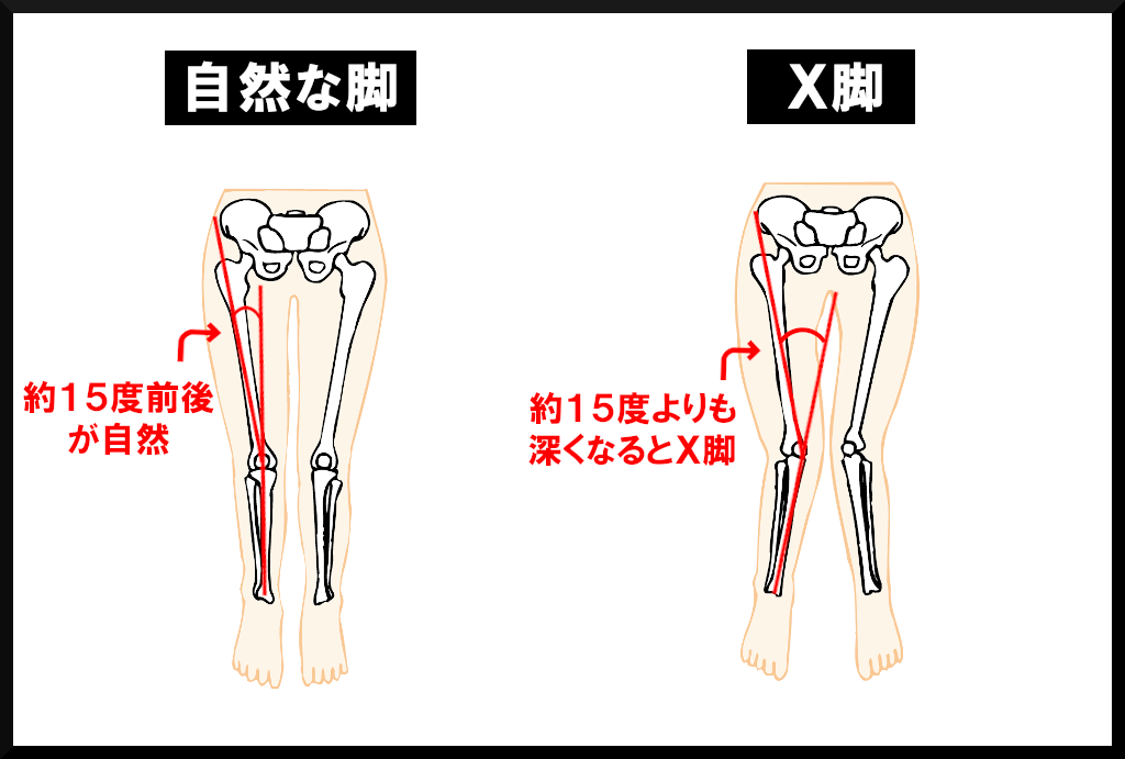 X脚の基準