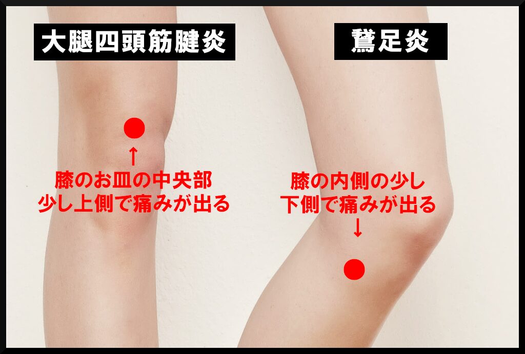 大腿四頭筋腱炎と鵞足炎