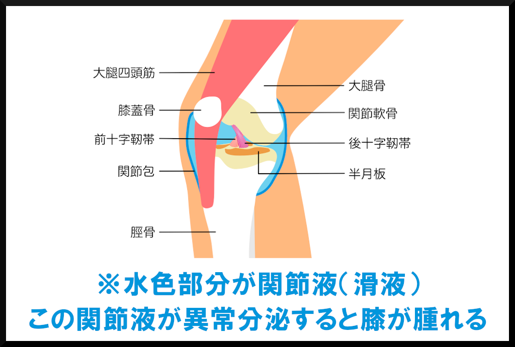 膝が腫れる解説